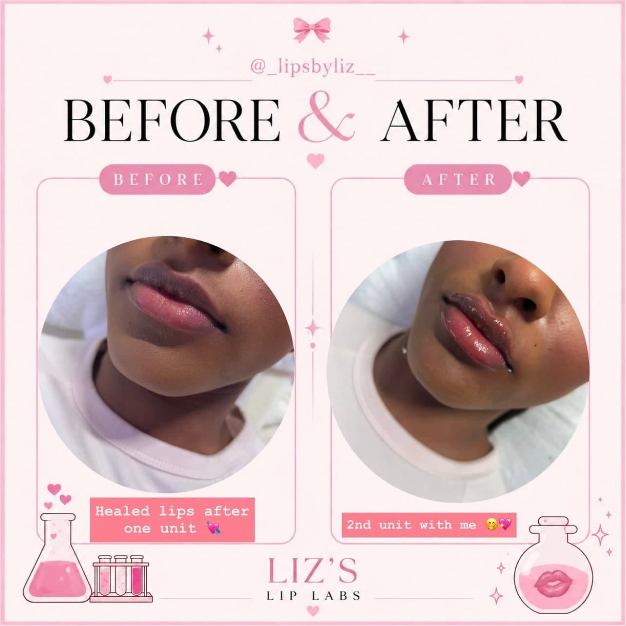 Lip filler before and after, photo 1: one client's lips healed after a first unit, then straight after a second unit