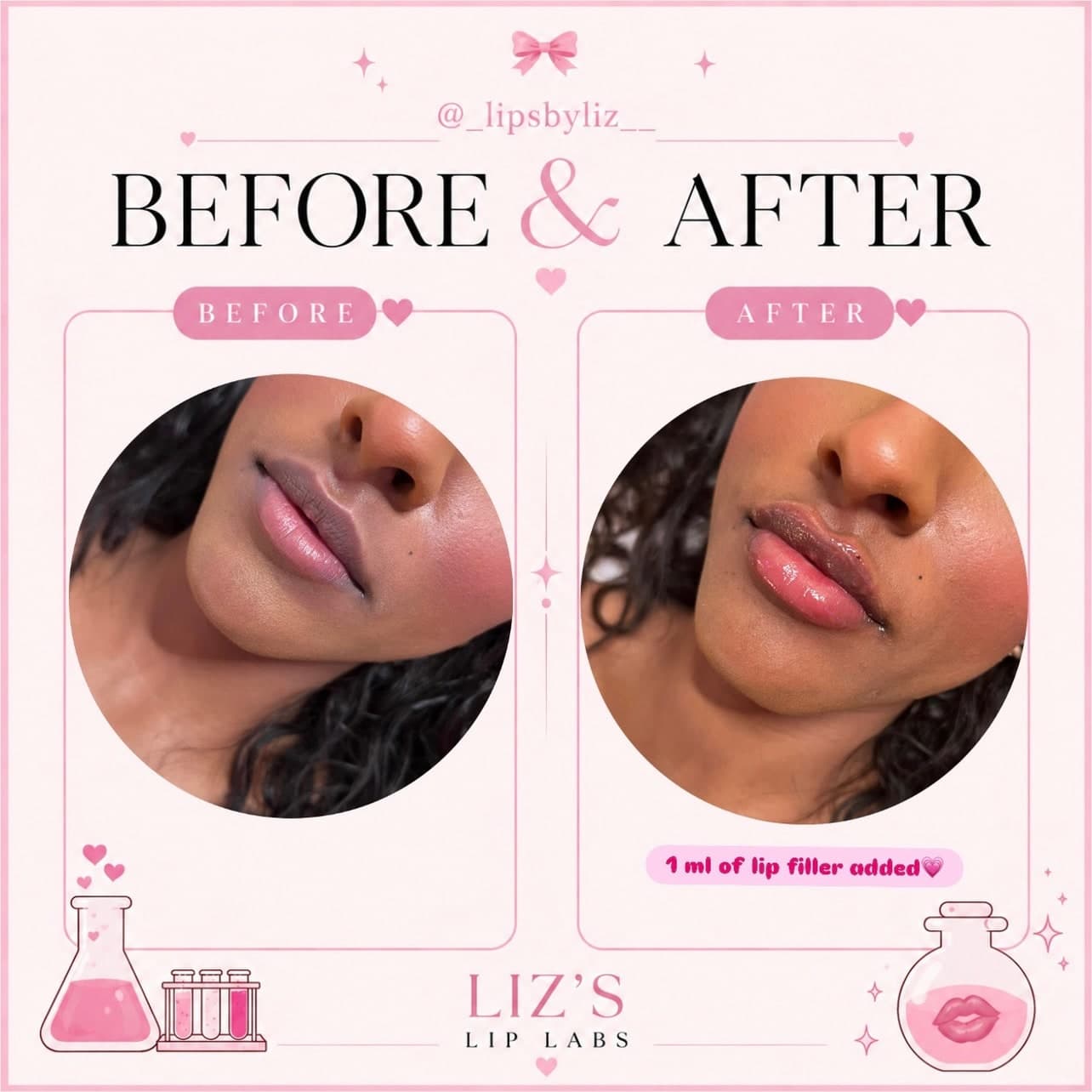 Lip filler before and after, photo 2: one client's lips before treatment and straight after 1 ml of lip filler