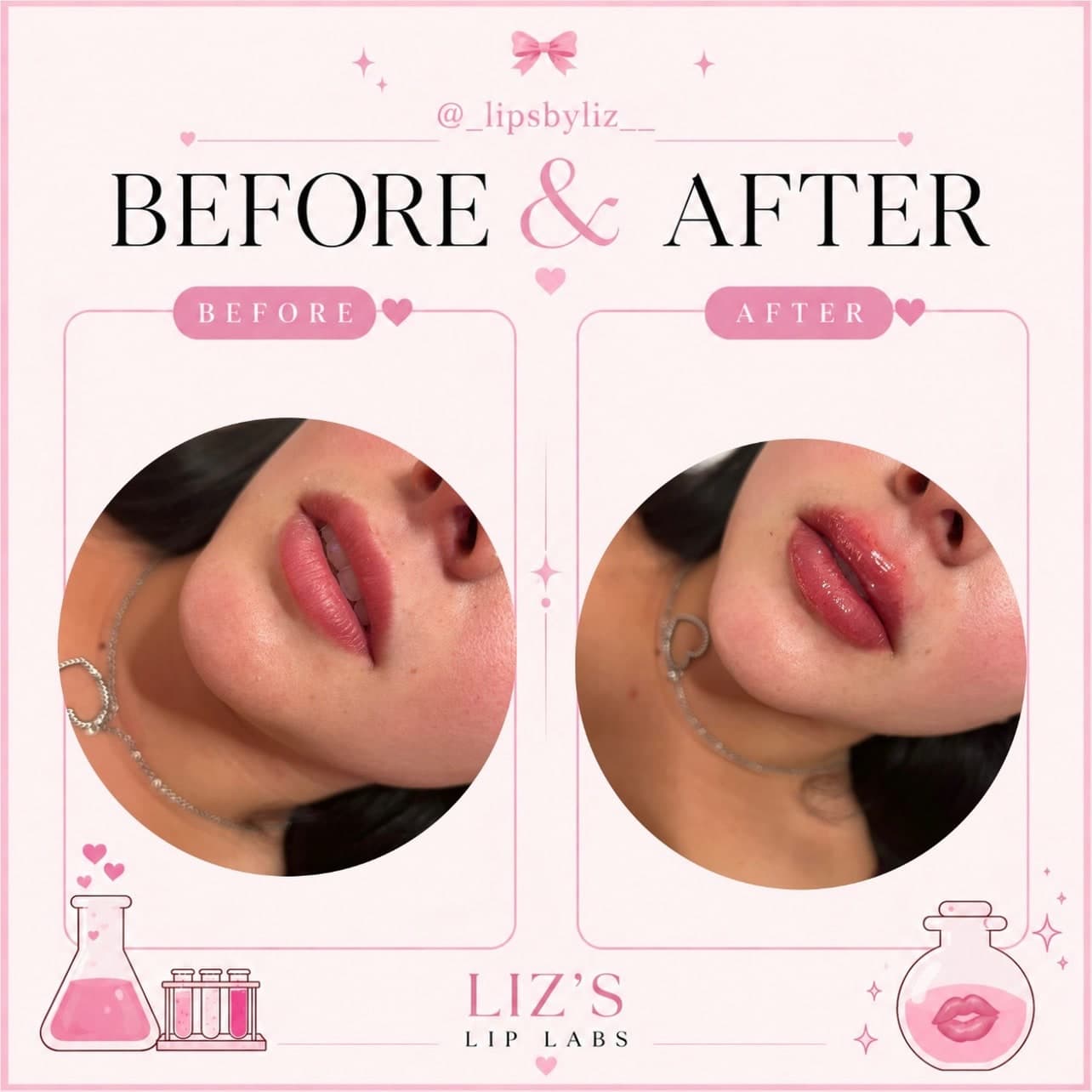 Lip filler before and after, photo 3: one client's lips before treatment and straight after, side view