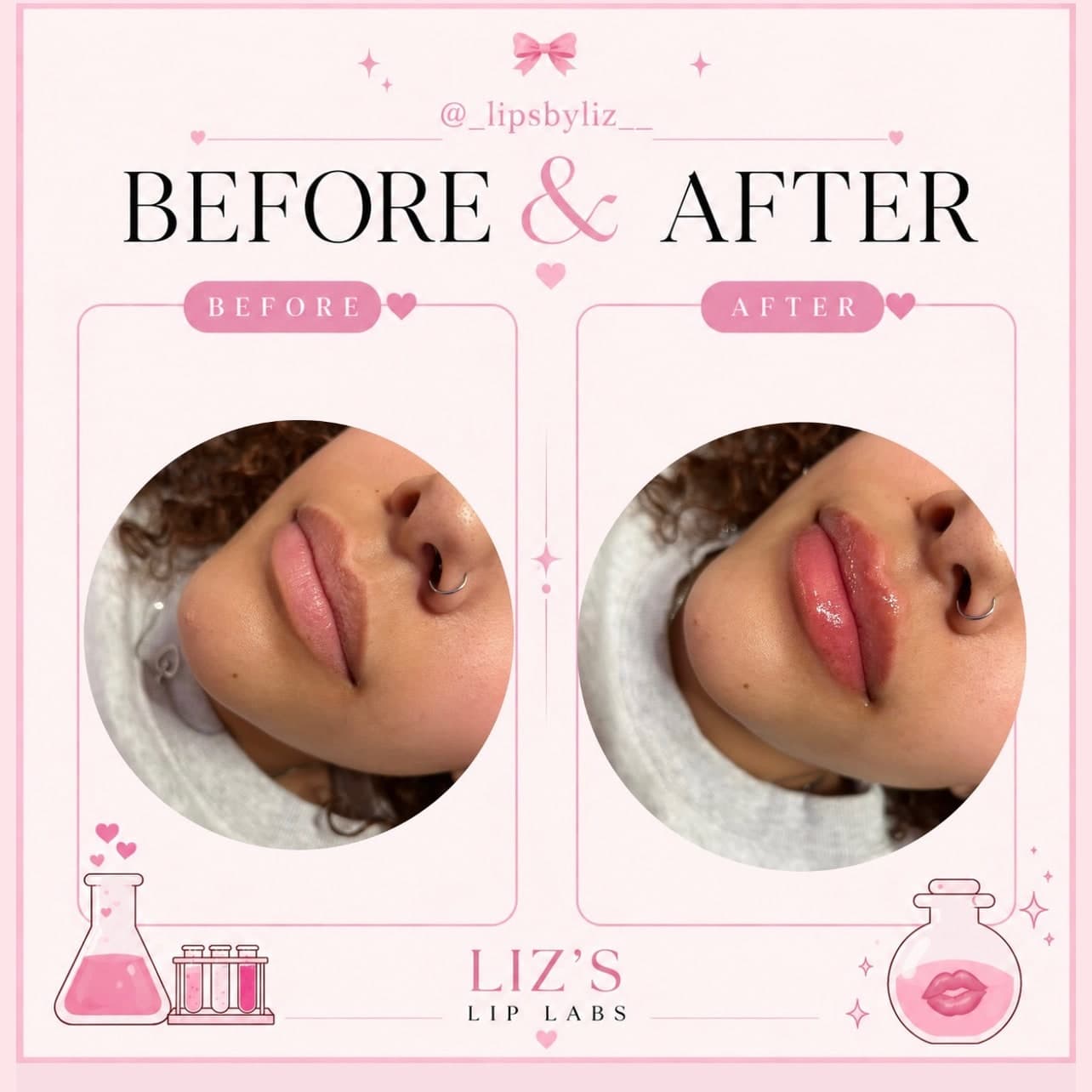 Lip filler before and after, photo 4: one client's lips before treatment and straight after, side view