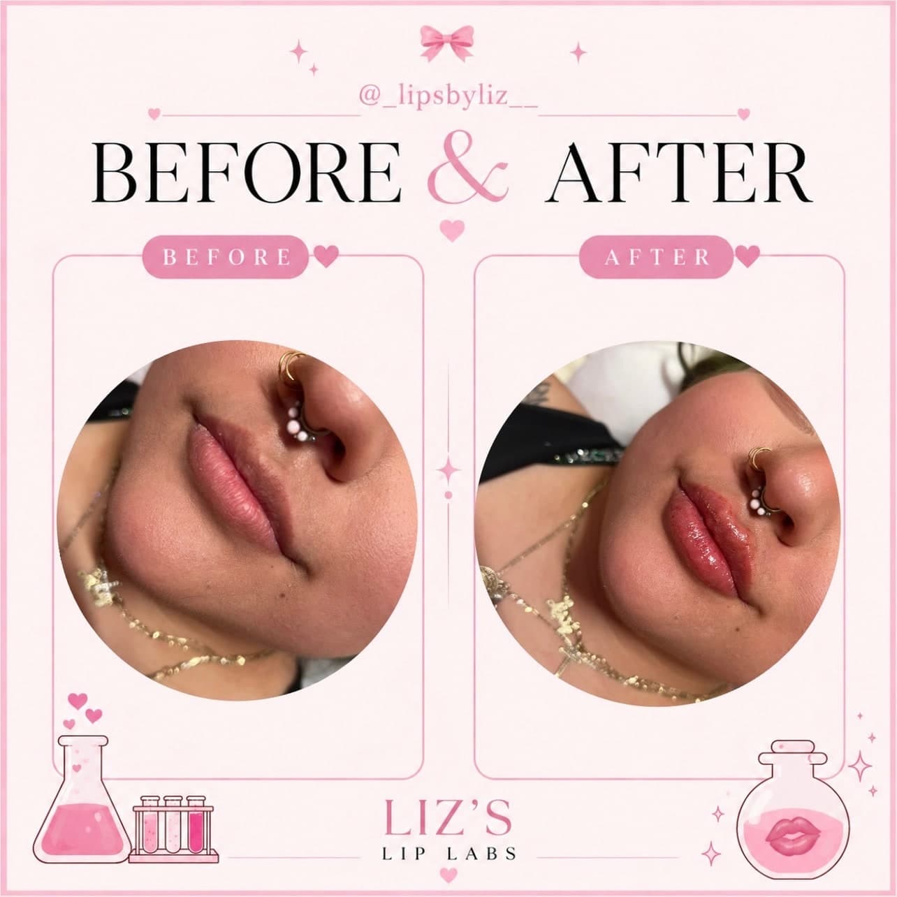 Lip filler before and after, photo 5: one client's lips before treatment and straight after, three-quarter view