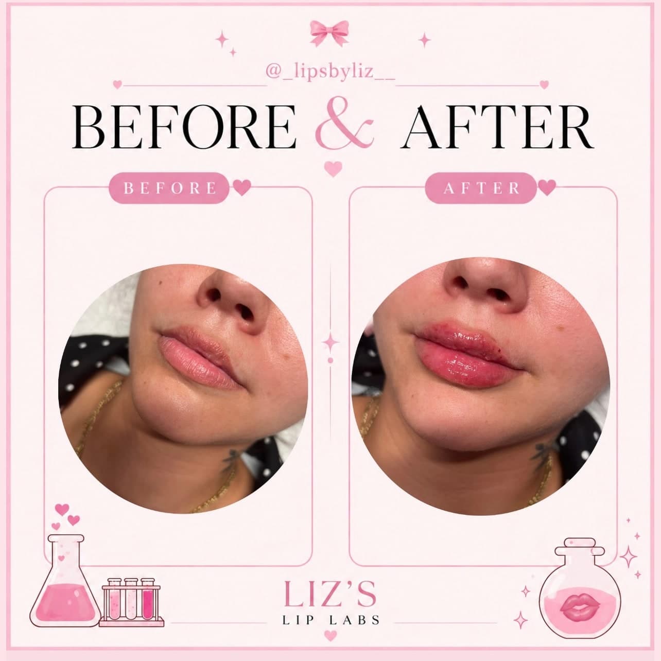 Lip filler before and after, photo 6: one client's lips before treatment and straight after, three-quarter view