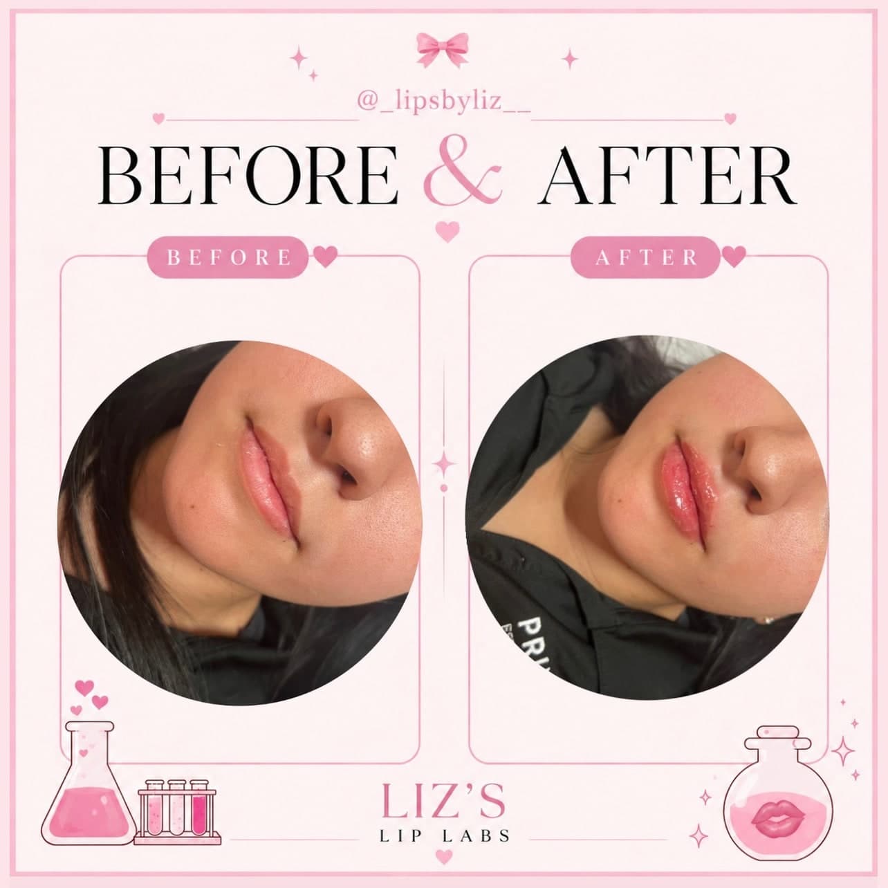 Lip filler before and after, photo 7: one client's lips before treatment and straight after, side view